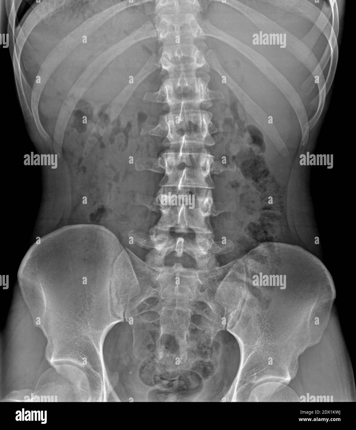 Wirbelsäulenradiographie eines Krankenhauspatienten Stockfoto