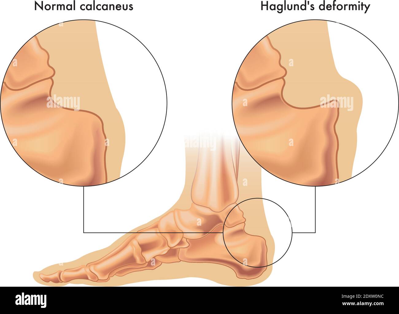 Medizinische Illustration zeigt den Vergleich zwischen einem normalen Calcaneus und einem von Haglunds Deformität betroffenen, mit Anmerkungen. Stock Vektor