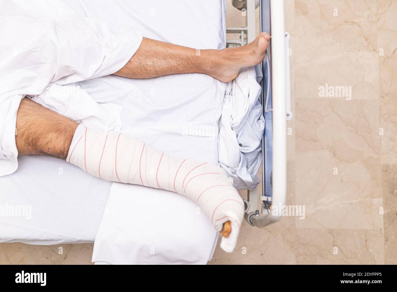 Patient liegt im Krankenhausbett mit gebrochenem Bein. Draufsicht. Krankenhausaufenthalt und medizinisches Versorgungskonzept. Stockfoto