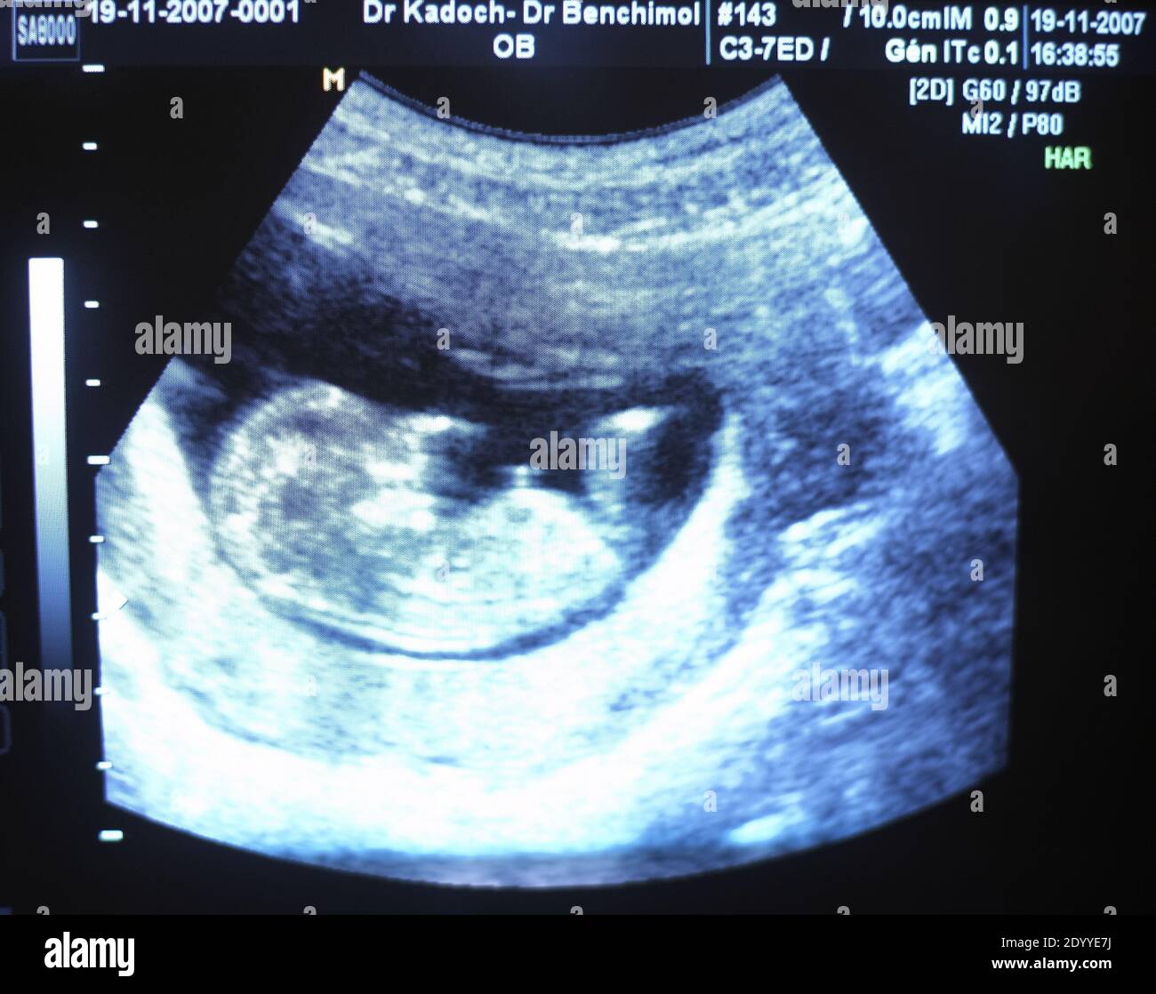 Ultraschall-Scan für eine Schwangerschaft in oder in der Nähe von 12 Wochen mit dem Kopf und den Beinen des Babys Stockfoto