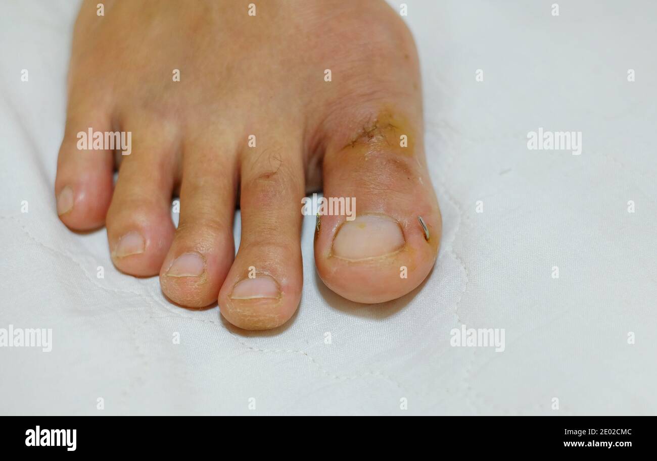 Fuß große Zehe Bandage verletzte Füße in der medizinischen Klinik  Krankenhaus Zentrum Stockfotografie - Alamy