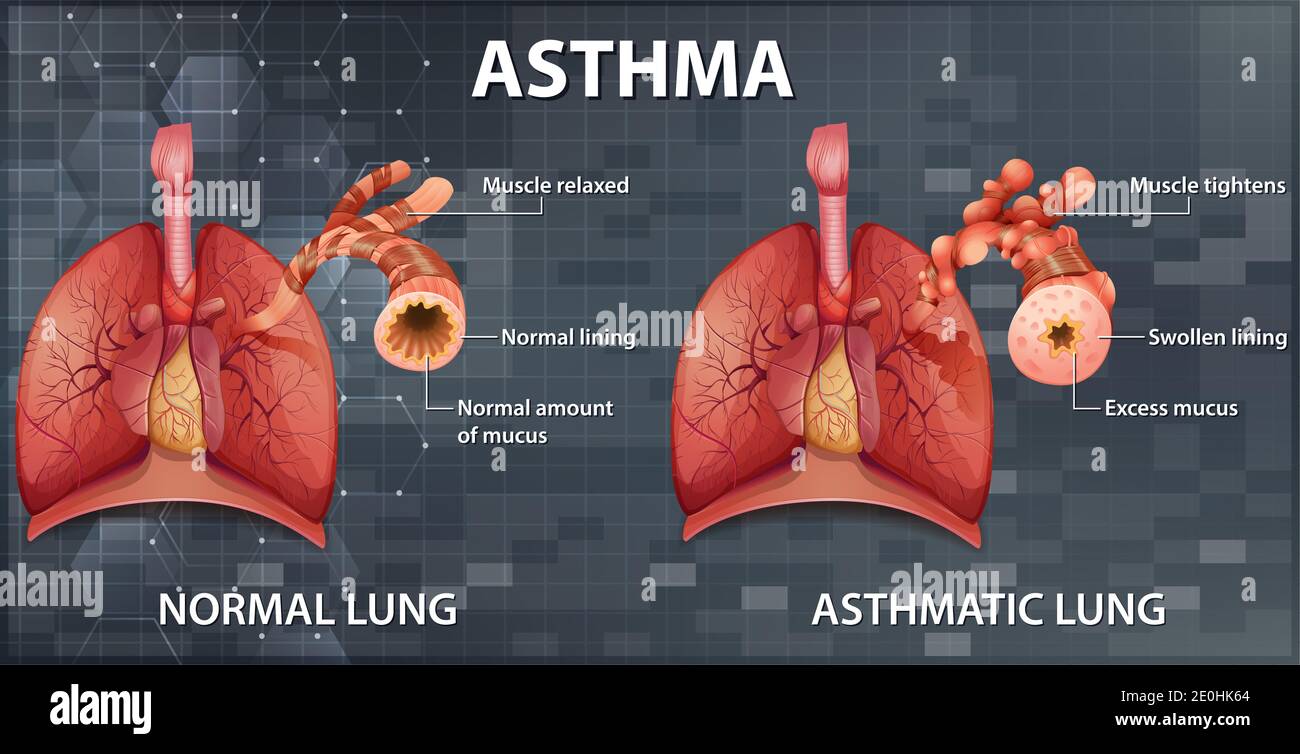 Vergleich von gesunder Lunge und asthmatischer Lunge Abbildung Stockfoto