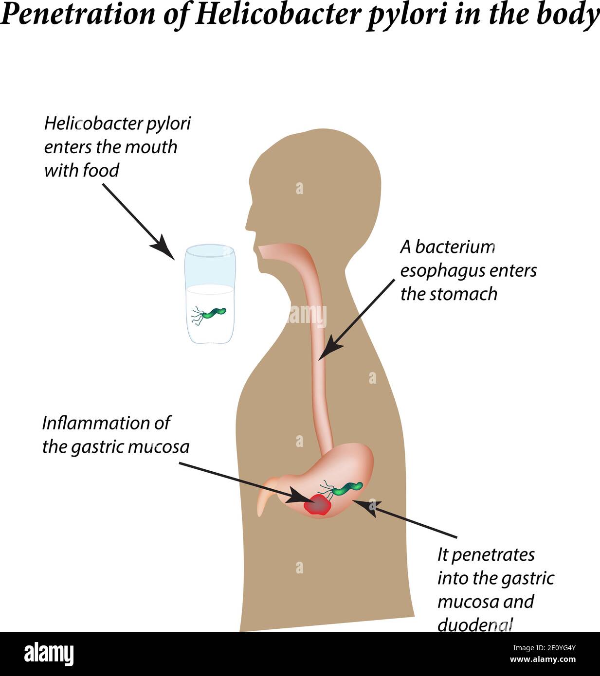 Infektion mit Helicobacter pylori. Infografiken. Vektorgrafik auf isoliertem Hintergrund Stock Vektor