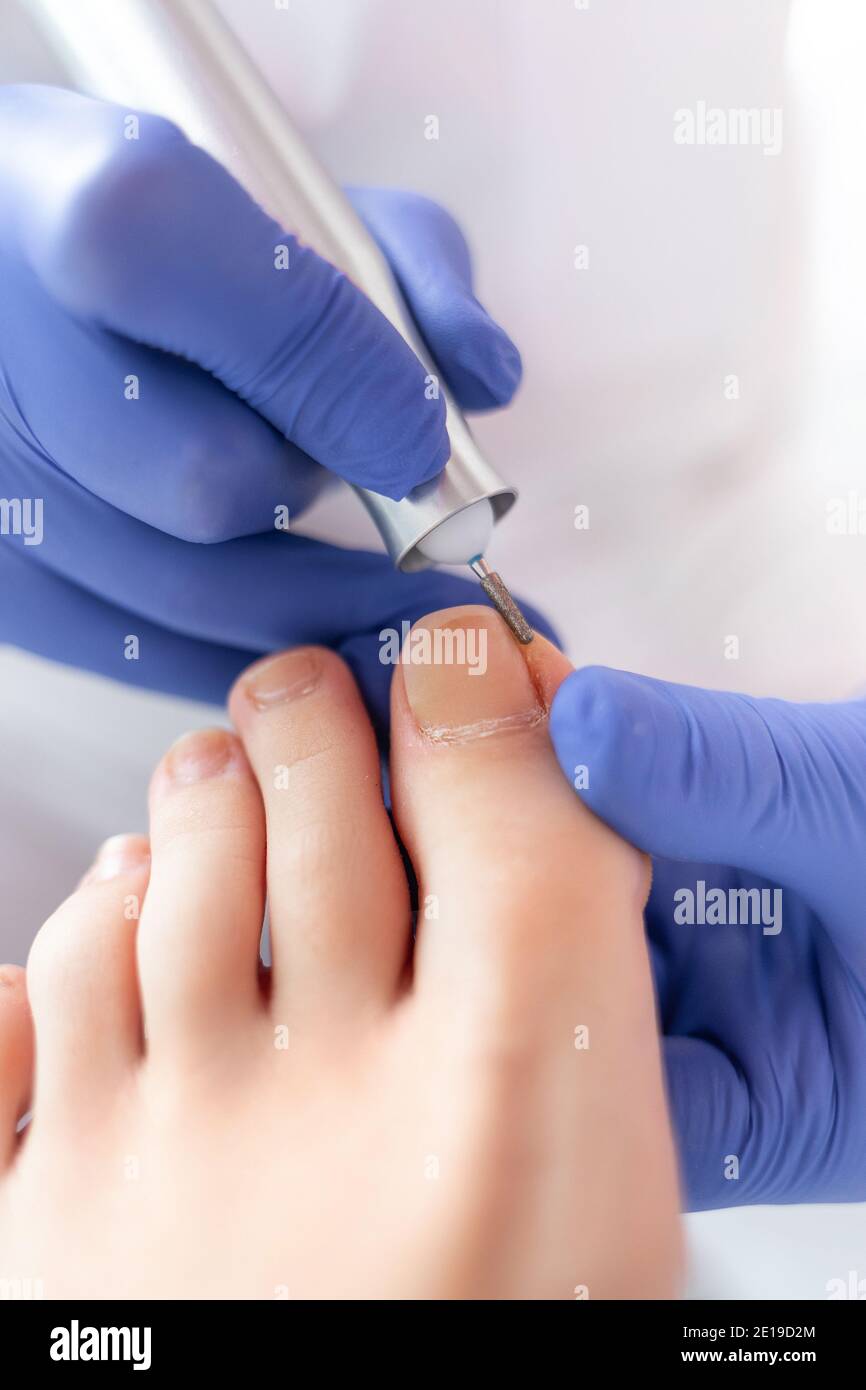 Peeling Füße mit speziellen elektrischen Gerät.Professionelle Hardware Pediküre mit elektrischen Maschine.Patient auf medizinische Pediküre Verfahren, Besuch Stockfoto