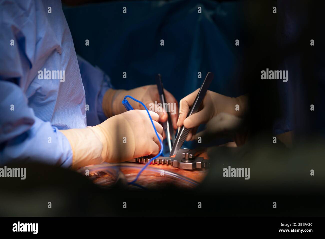 Hände von Chirurgen während der Herz-Kreislauf-Chirurgie Stockfoto