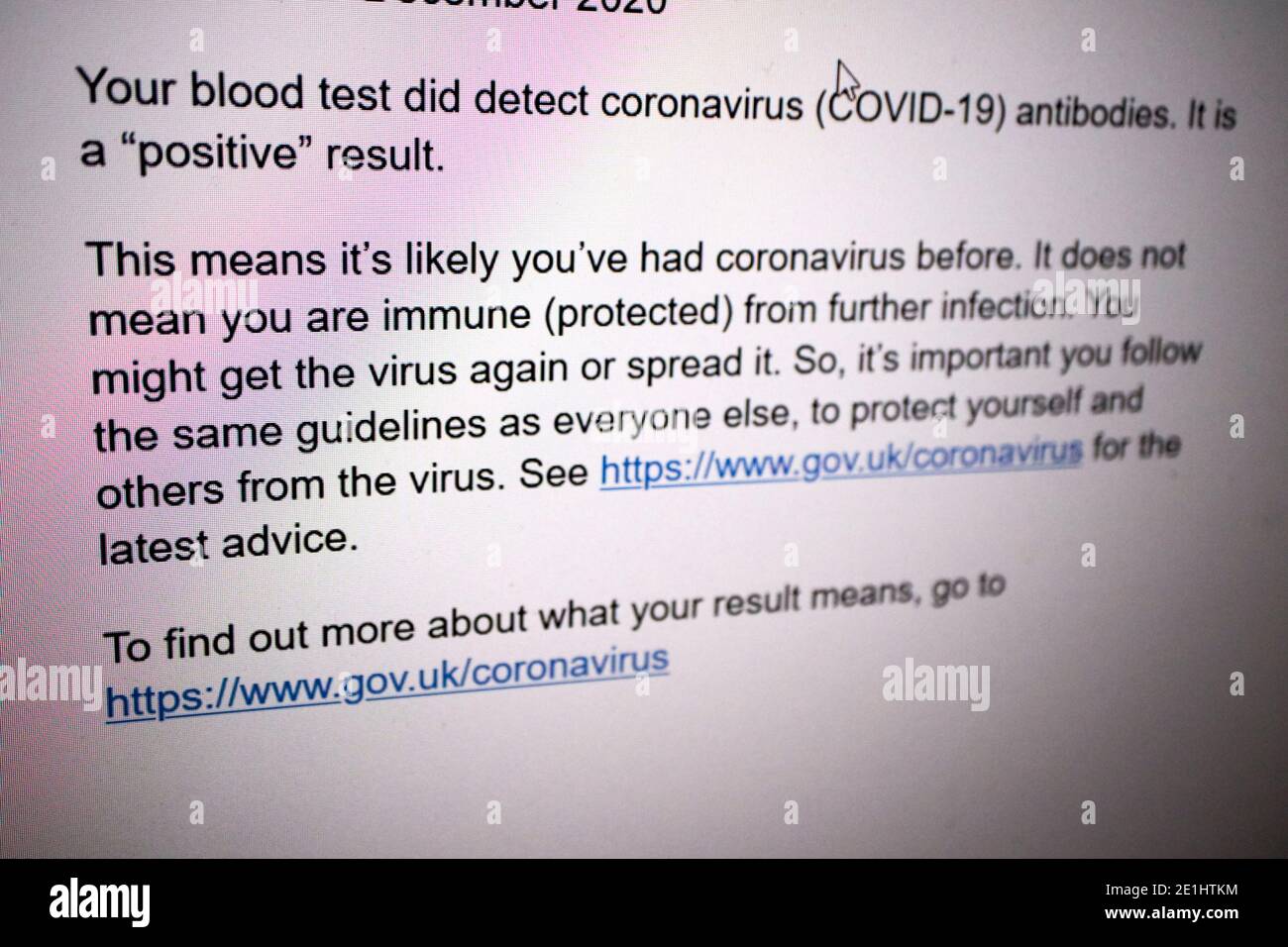 Bildschirmmeldung, die ein positives Ergebnis eines nhs ergibt Covid-19-Antikörper-Bluttest auf Coronavirus-Antikörper, die in empfangen wurden vereinigtes Königreich Stockfoto
