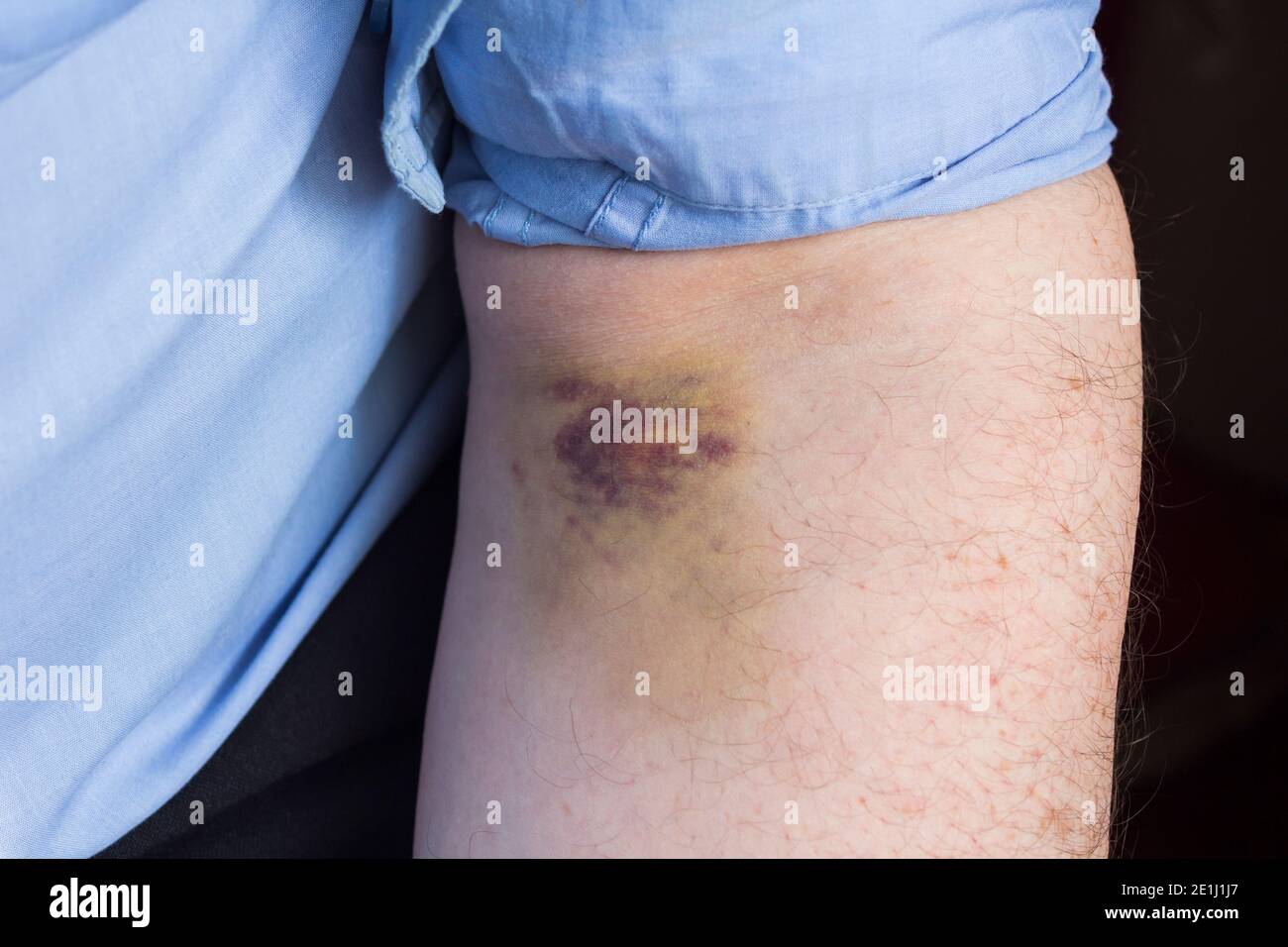 Leichte bis mäßige Blutergüsse am Oberarm eines Mannes in den Tagen nach der Entnahme einer Blutprobe. Stockfoto
