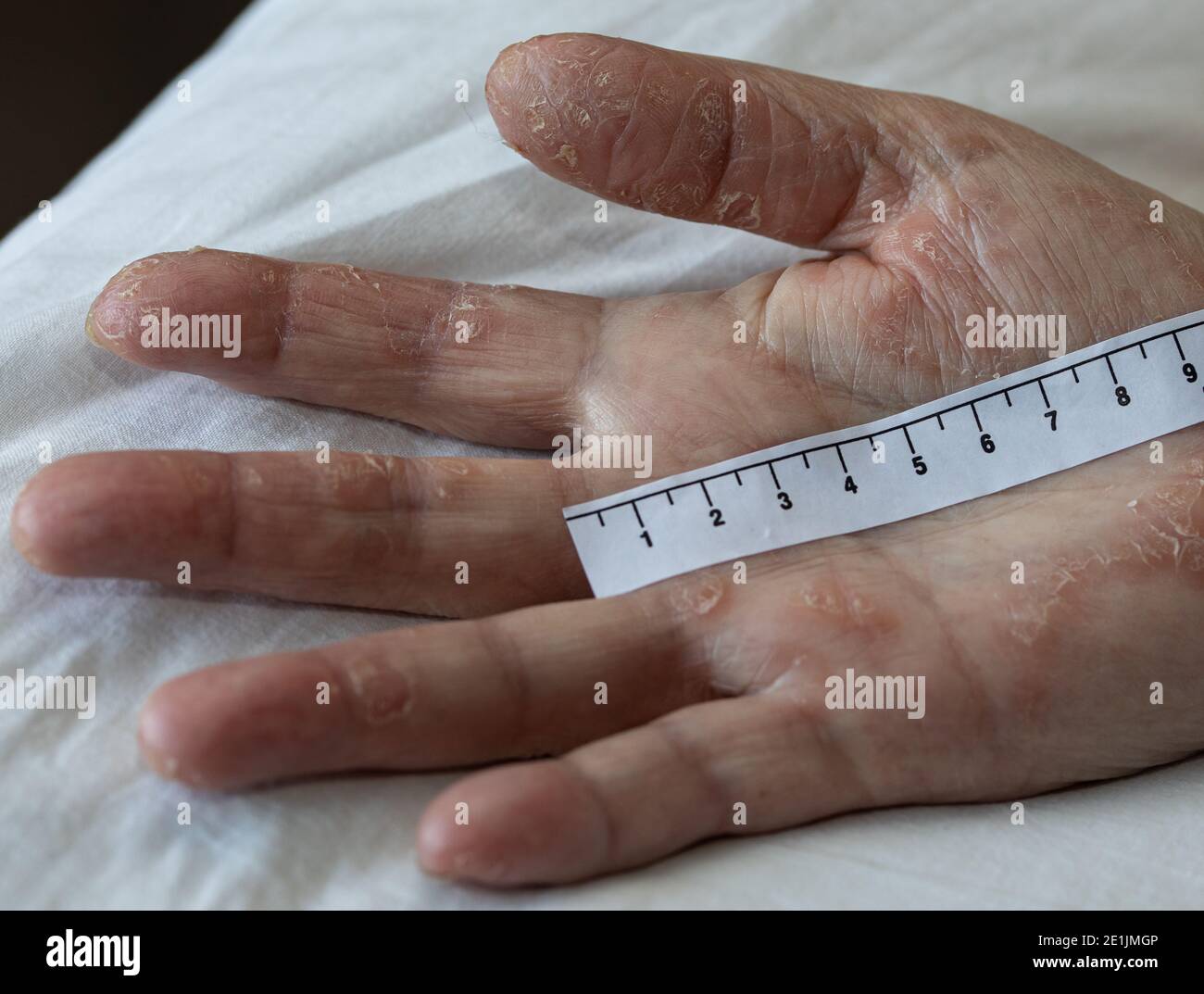 Eine rechte Hand mit extrem trockener und hart verdickter Haut Zusammen mit roter Dermatitis Stockfoto