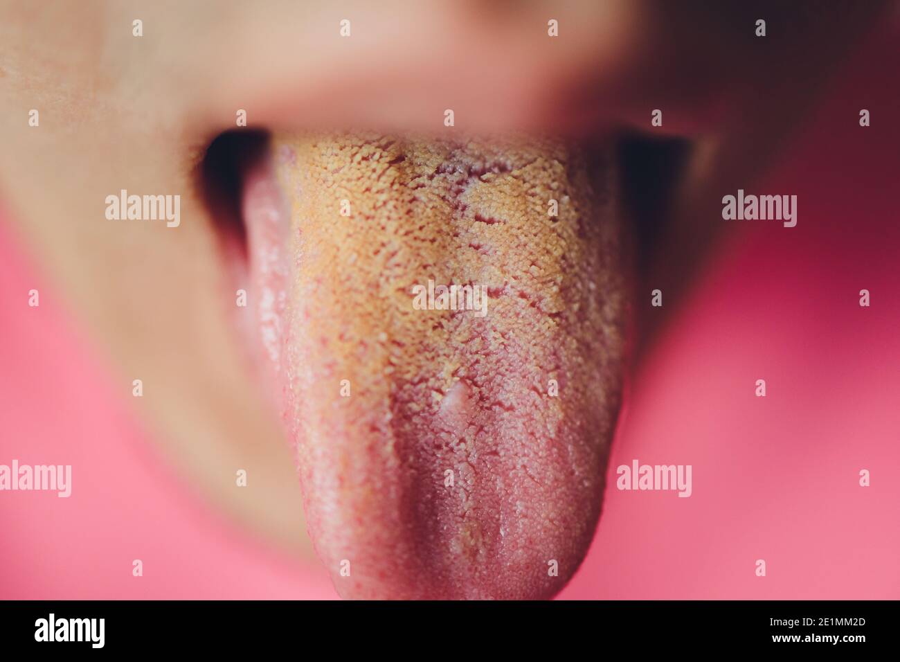 Schmutzige Zunge, Nahaufnahme, gelb wegen Krankheit Stockfotografie - Alamy