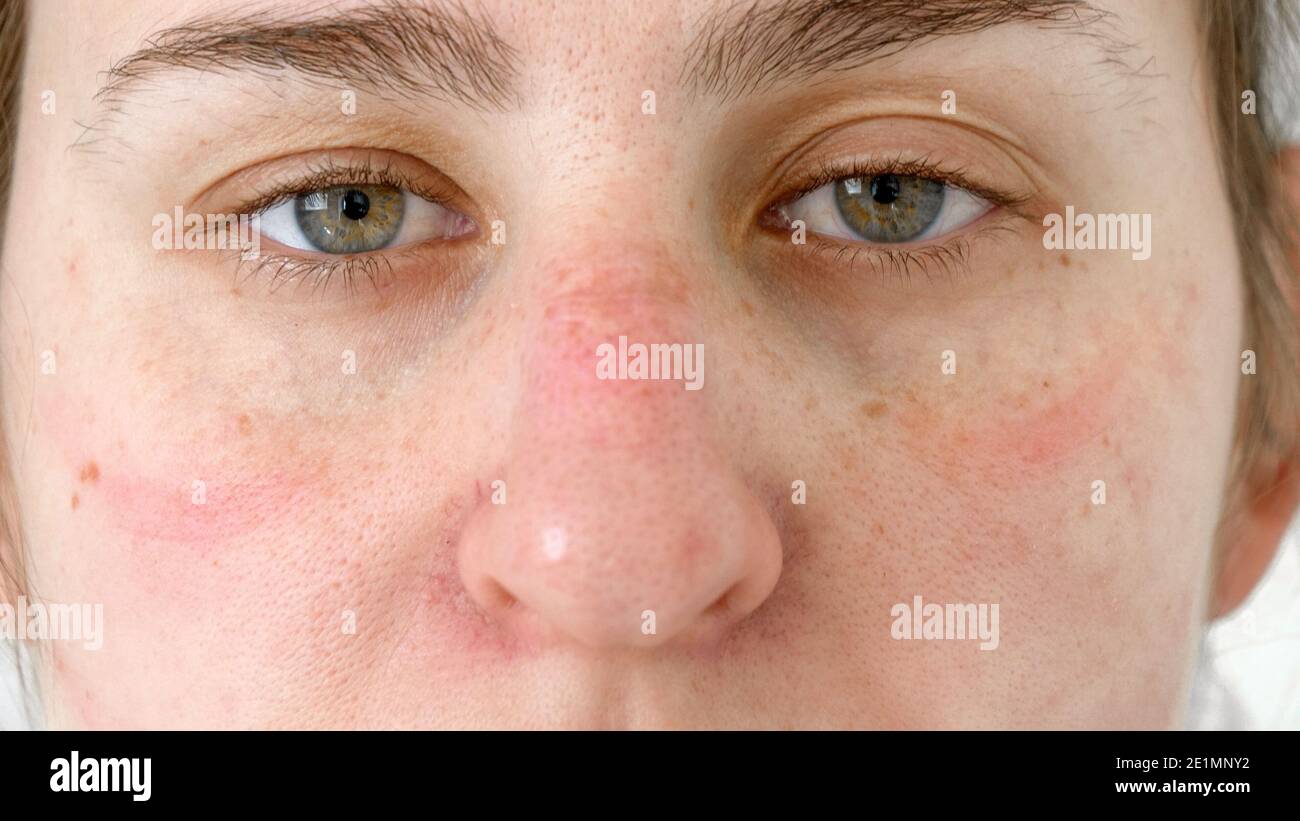 Bluterguss Im Gesicht Schnell Wegbekommen www.alamy.de