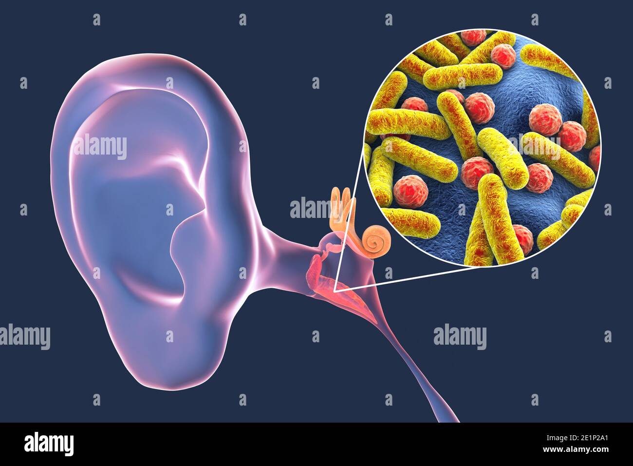 Otitis Media Ohrinfektion, Abbildung Stockfoto