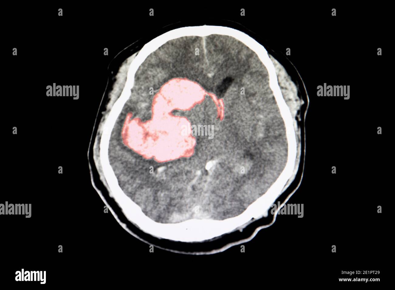 Ein CT-Scan eines Schlaganfallpatienten, der intrazerebrale Blutungen in den CD-Gerinnseln am rechten Thalamus, am Basalganglikon und am lateralen Ventrikel mit Gehirn zeigt Stockfoto