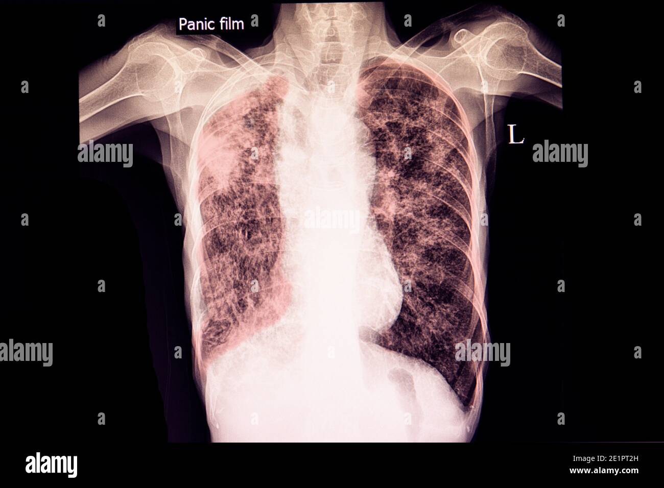 Röntgenfilm eines Patienten mit schwerer Lungentuberkulose mit emphysematöser Lunge. Stockfoto