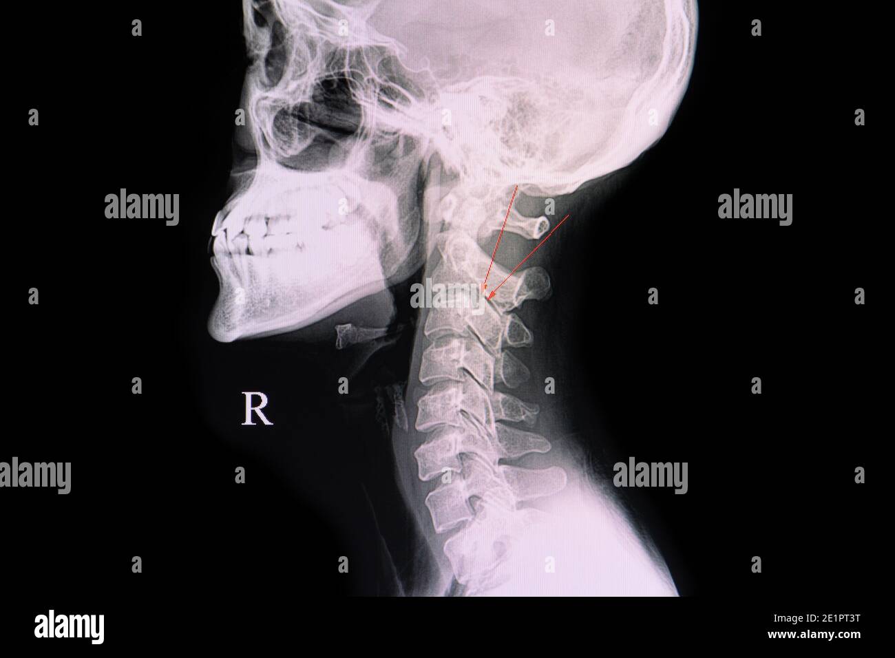 C- Dornen Röntgenaufnahme eines Patienten mit Bruch des Pedialkörpers C3 vertebrale. Stockfoto