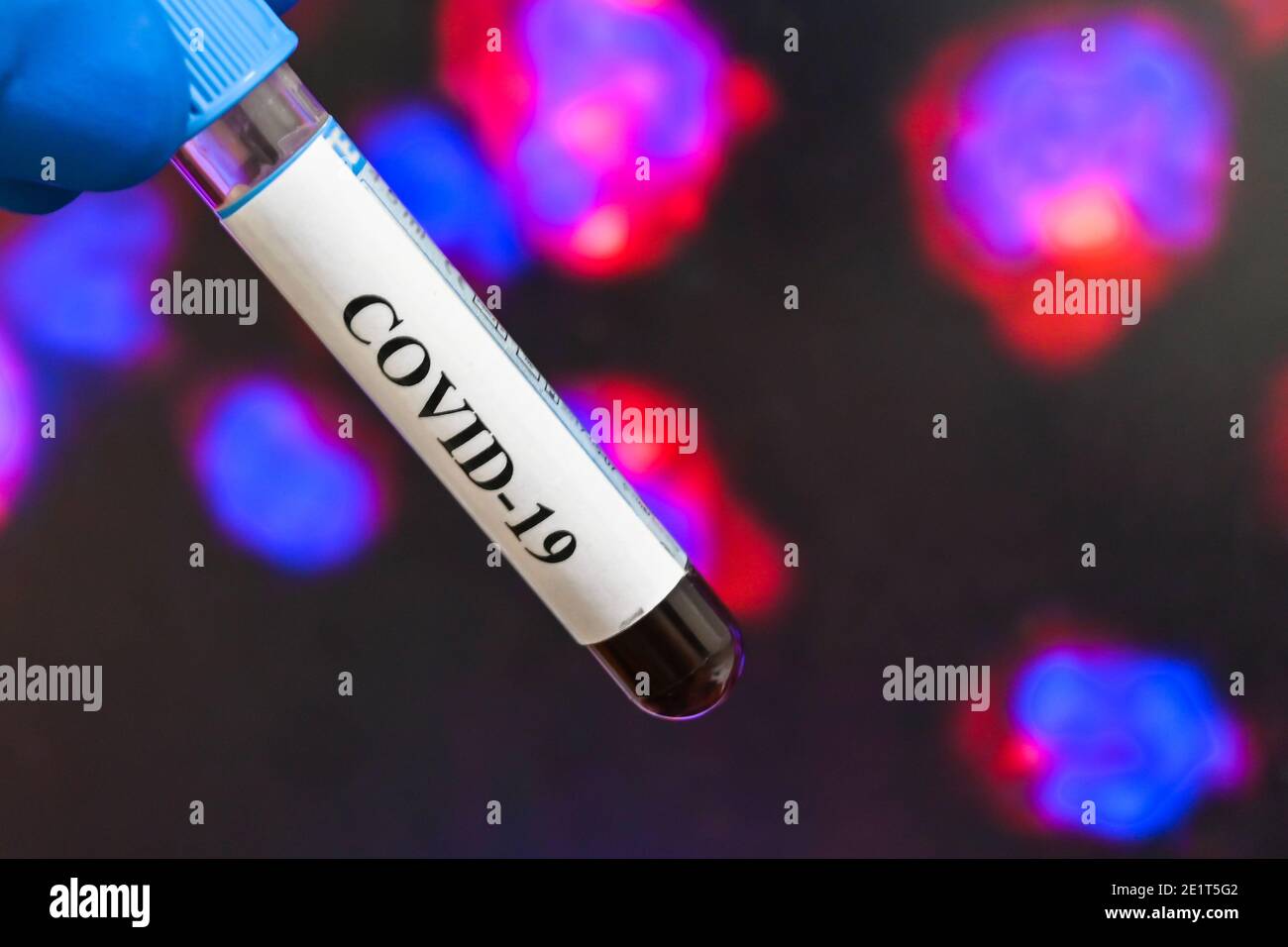 Coronavirus-Test. Nachweis von Antikörpern gegen COVID-19 in einer Blutprobe. Stockfoto