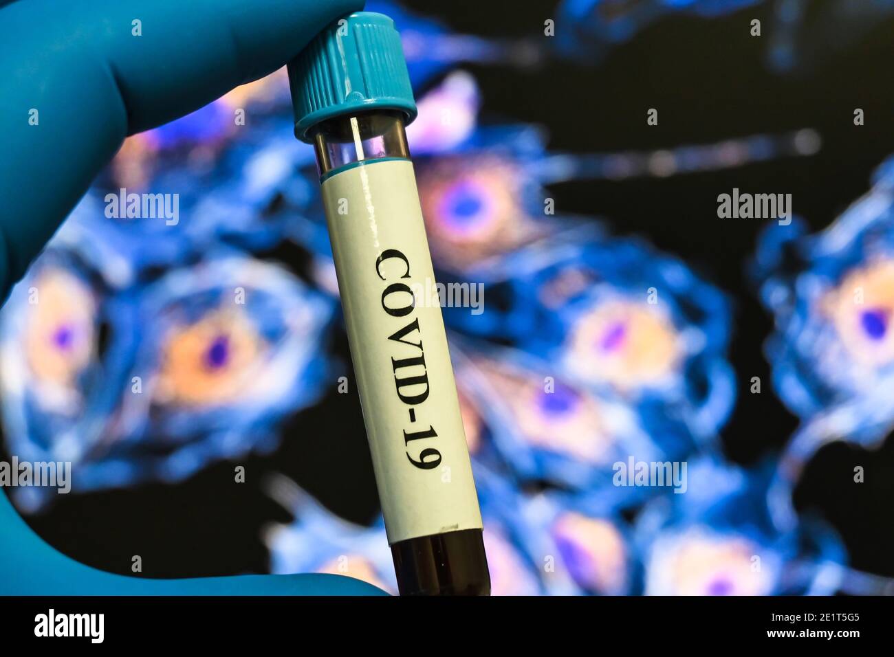 Coronavirus-Test. Nachweis von Antikörpern gegen COVID-19 in einer Blutprobe. Stockfoto