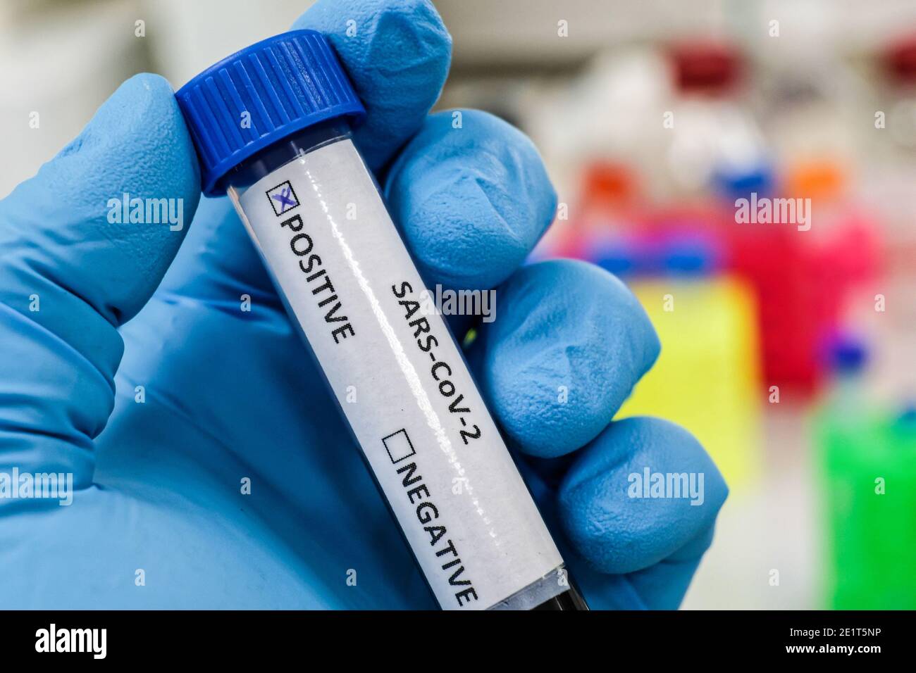 Coronavirus-Test. Nachweis von Antikörpern gegen COVID-19 in einer Blutprobe. Stockfoto