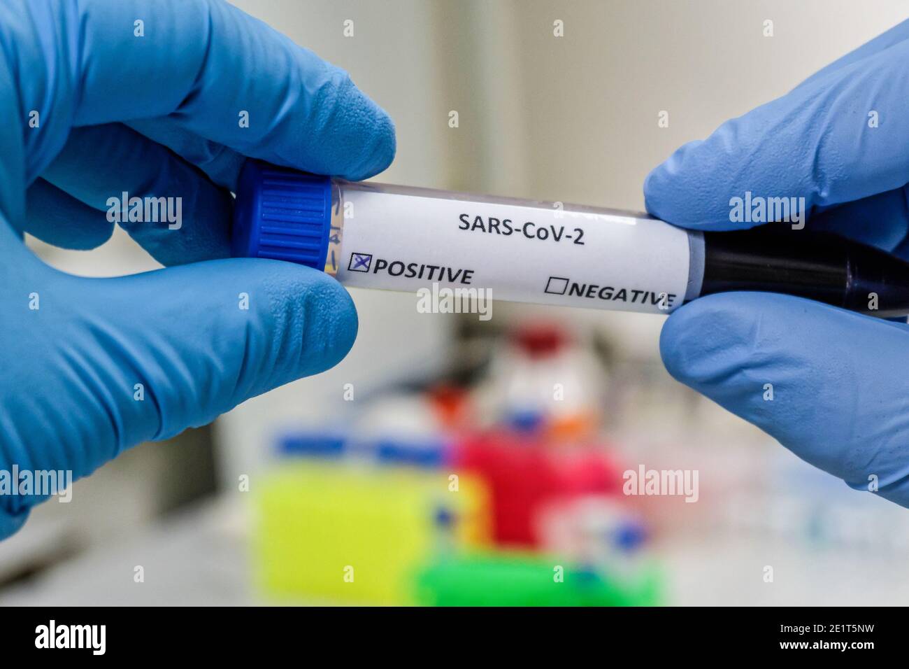 Coronavirus-Test. Nachweis von Antikörpern gegen COVID-19 in einer Blutprobe. Stockfoto