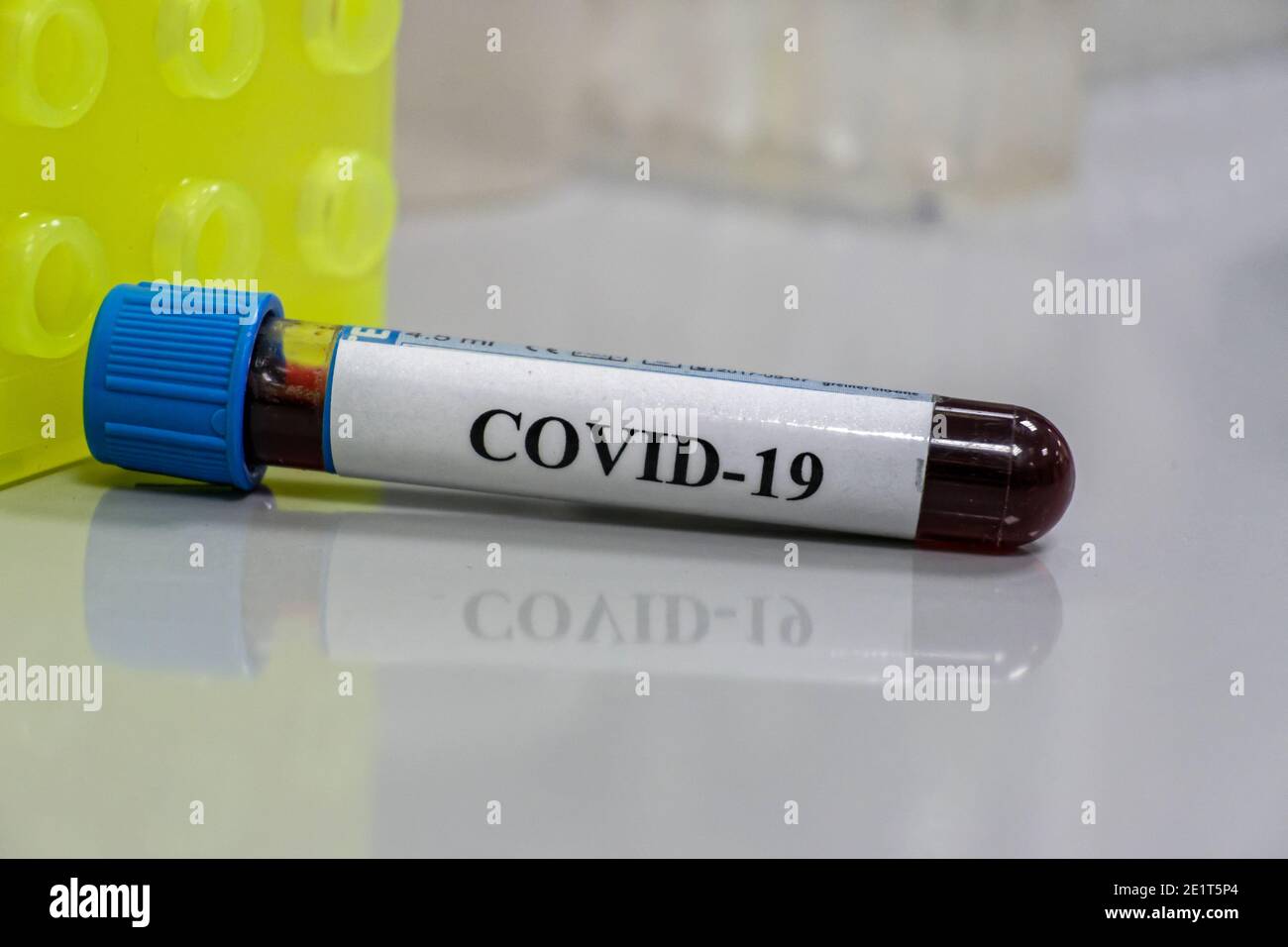 Coronavirus-Test. Nachweis von Antikörpern gegen COVID-19 in einer Blutprobe. Stockfoto