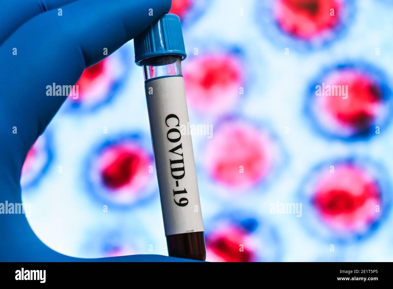 Coronavirus-Test. Nachweis von Antikörpern gegen COVID-19 in einer Blutprobe. Stockfoto