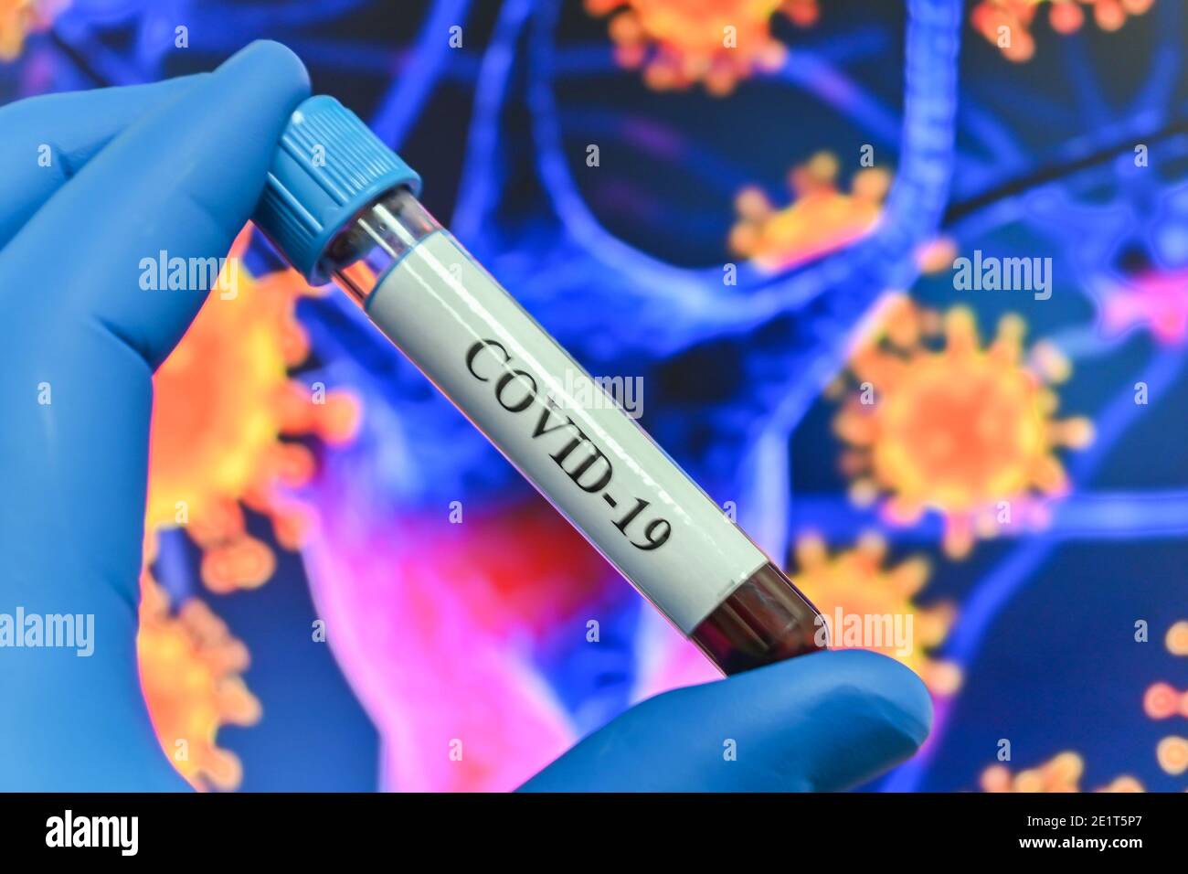 Coronavirus-Test. Nachweis von Antikörpern gegen COVID-19 in einer Blutprobe. Stockfoto