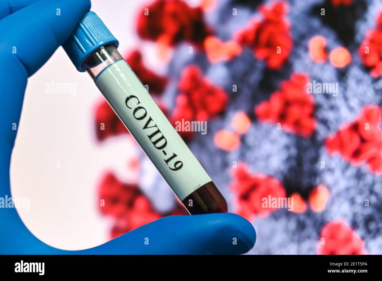 Coronavirus-Test. Nachweis von Antikörpern gegen COVID-19 in einer Blutprobe. Stockfoto