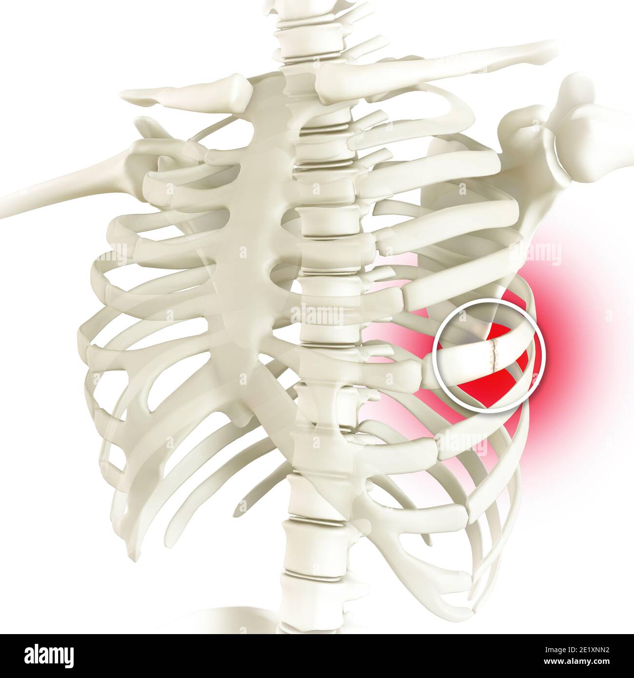 Anatomie und der menschliche Körper. Costochondral Trennung, getrennte Rippe. Gebrochene