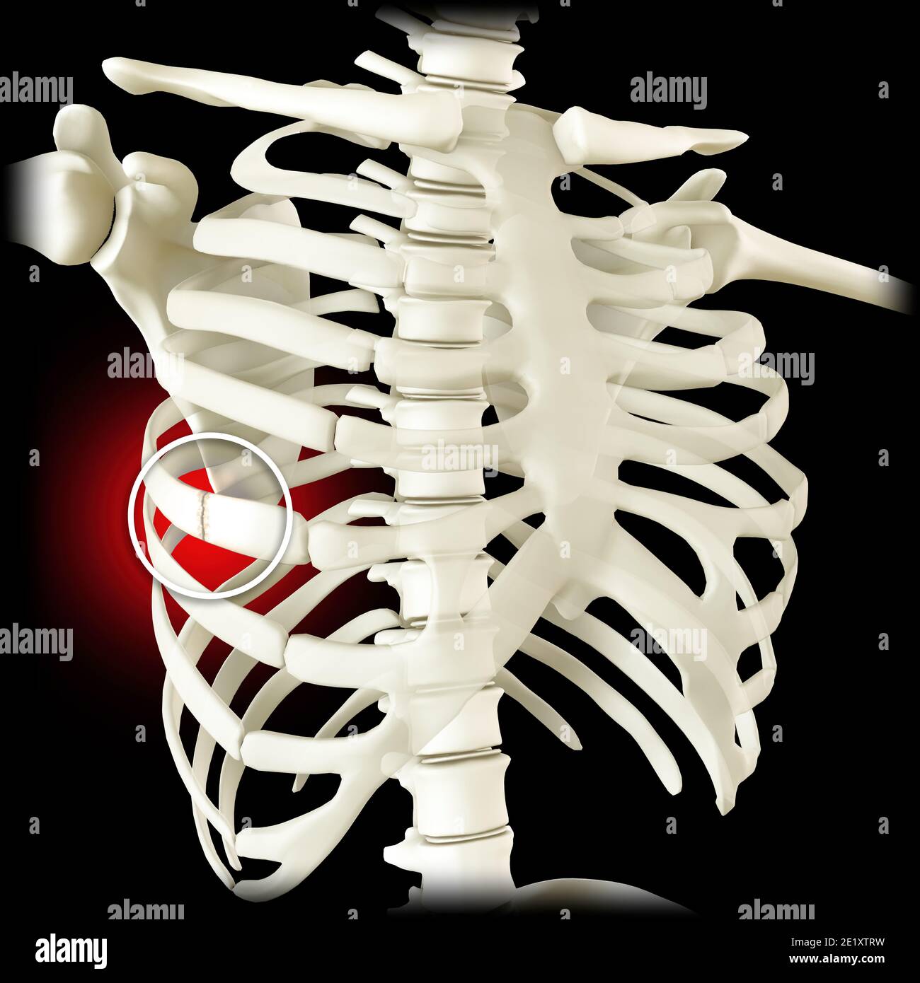 Anatomie und der menschliche Körper. Costochondral Trennung, getrennte Rippe. Gebrochene