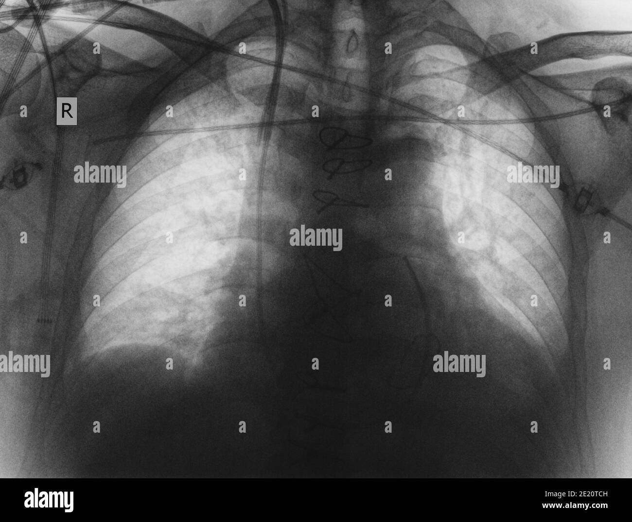 Röntgenbild des Patienten nach einer Herzoperation. Stockfoto