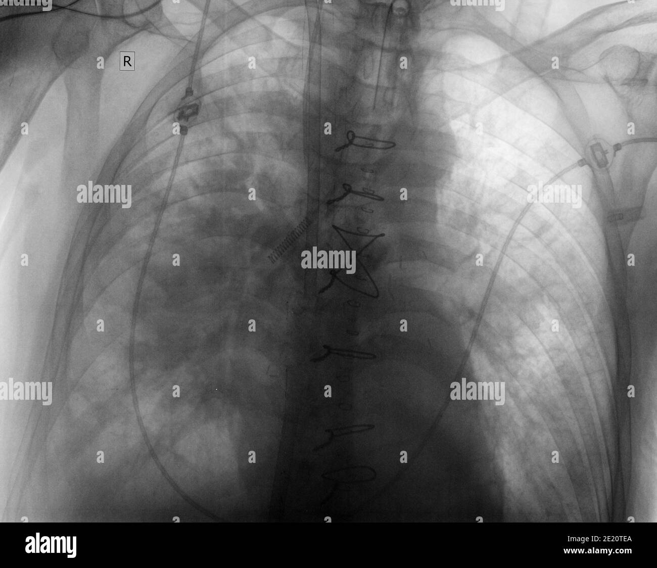 Röntgenbild eines Patienten mit Lungenentzündung. Stockfoto