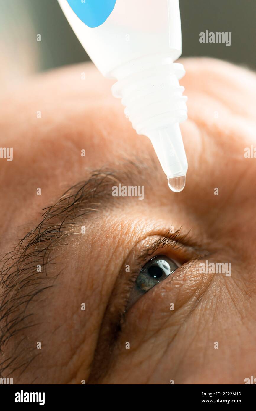 Ein Mann legt Augentropfen in seine Augen, bevor er Kontaktlinsen aufsetzt. Probleme mit der Lösungsvision. Stockfoto