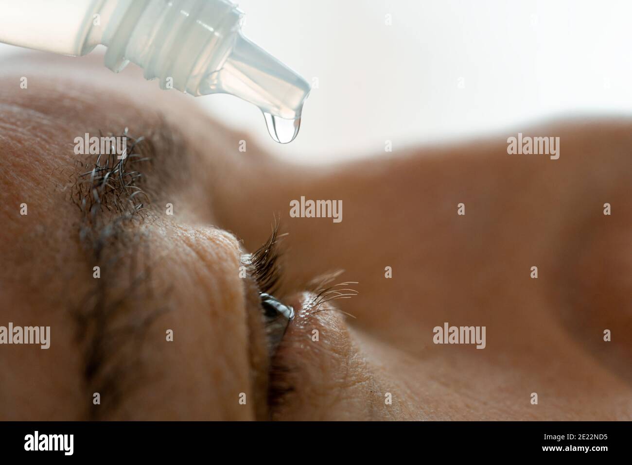 Ein Mann legt Augentropfen in seine Augen, bevor er Kontaktlinsen aufsetzt. Probleme mit der Lösungsvision. Stockfoto