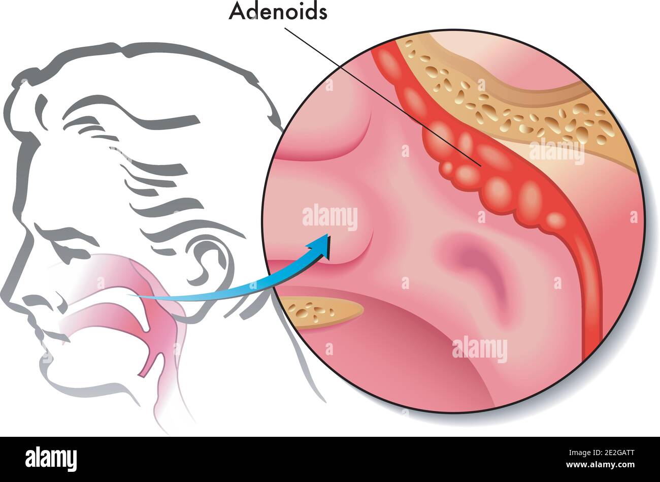 Mandeln und Adenoide entfernt