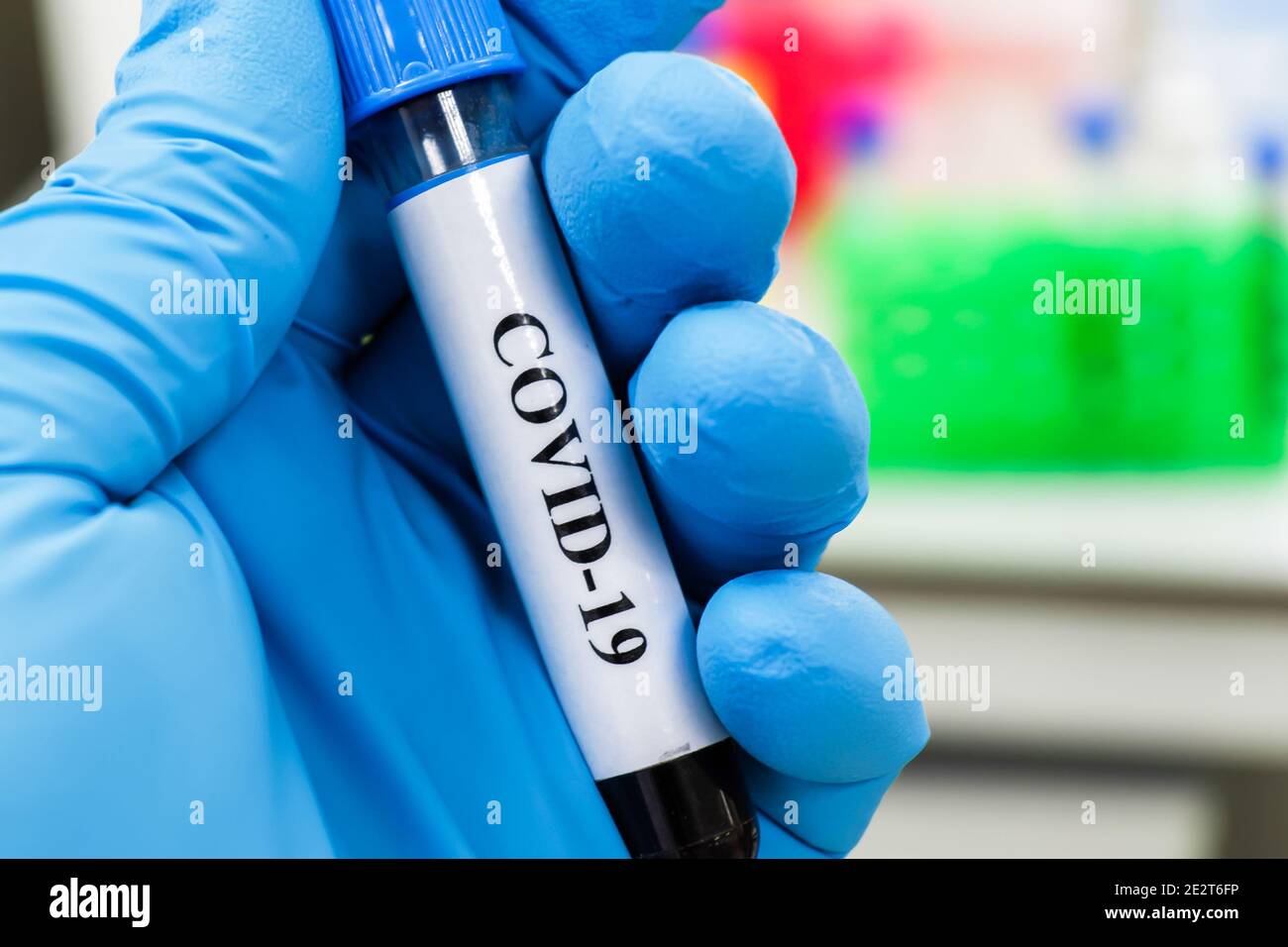 Nachweis von Antikörpern gegen das Coronavirus. Immunglobulintest nach COVID-19. Stockfoto