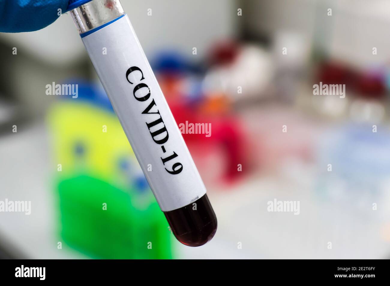 Nachweis von Antikörpern gegen das Coronavirus. Immunglobulintest nach COVID-19. Stockfoto