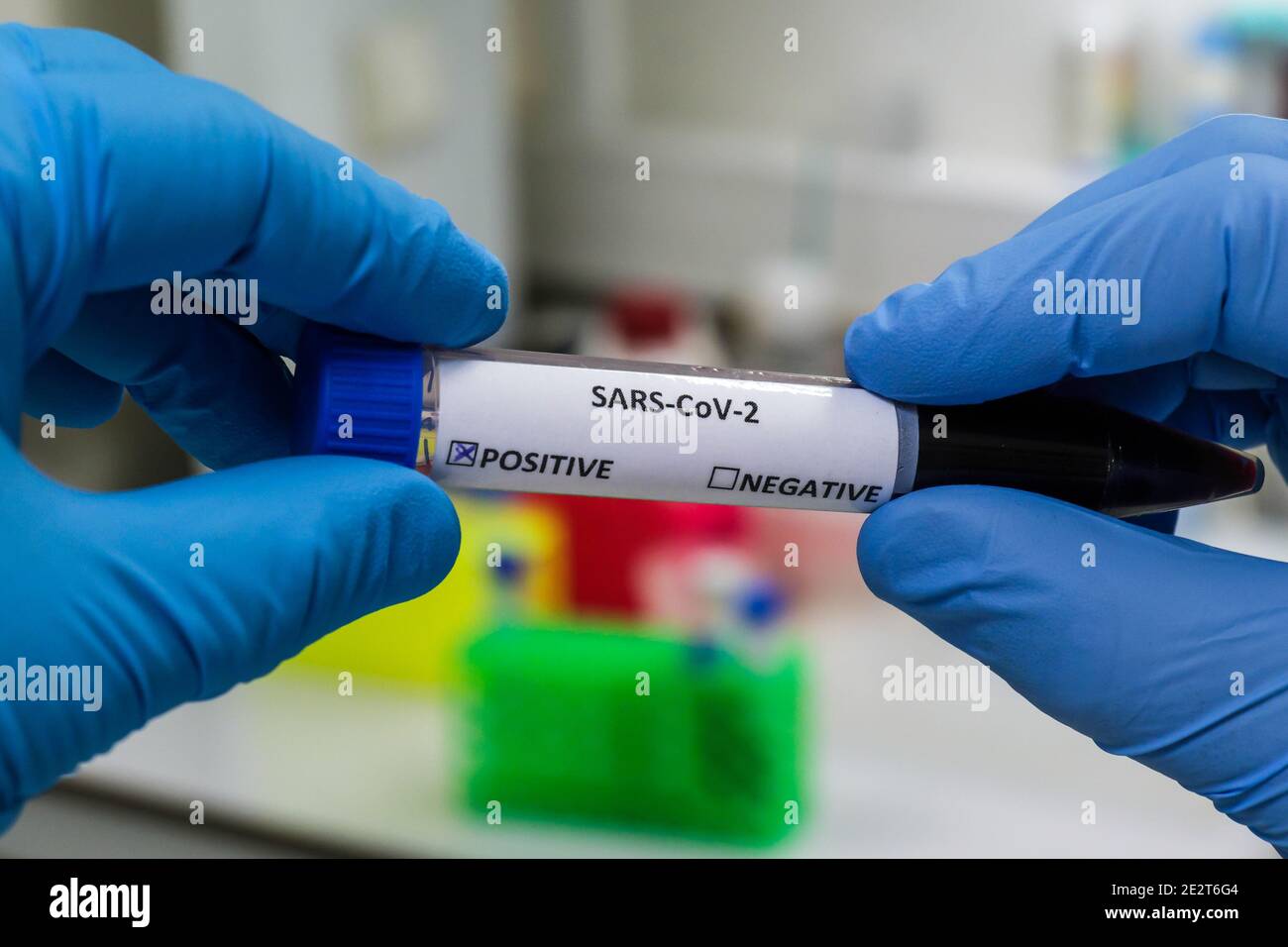 Nachweis von Antikörpern gegen das Coronavirus. Immunglobulintest nach COVID-19. Stockfoto