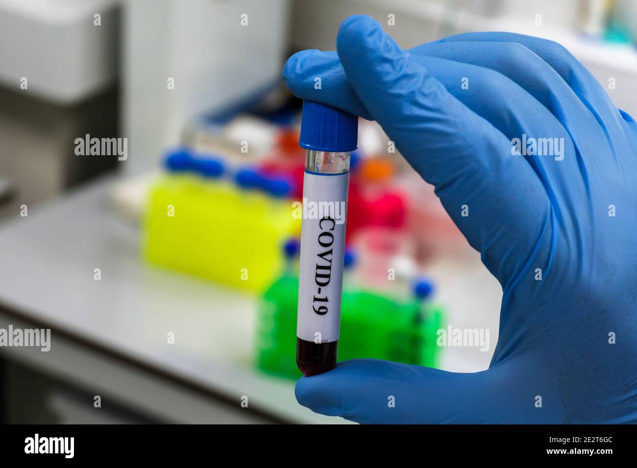 Nachweis von Antikörpern gegen das Coronavirus. Immunglobulintest nach COVID-19. Stockfoto