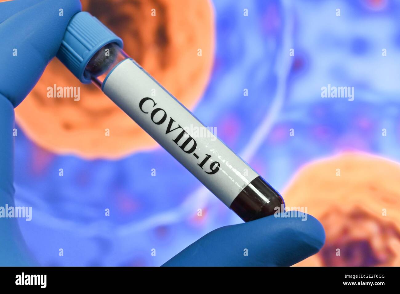 Nachweis von Antikörpern gegen das Coronavirus. Immunglobulintest nach COVID-19. Stockfoto