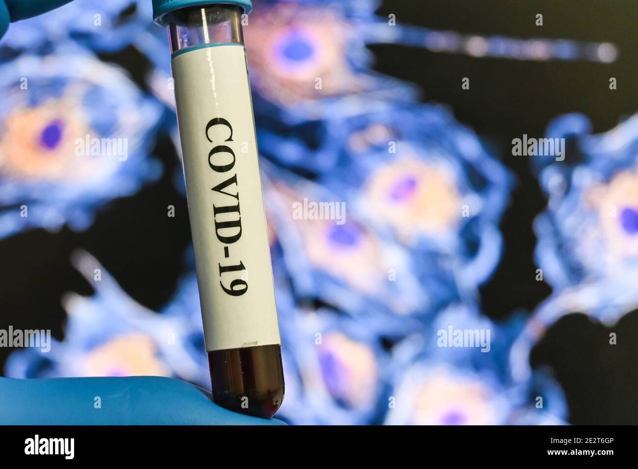 Nachweis von Antikörpern gegen das Coronavirus. Immunglobulintest nach COVID-19. Stockfoto