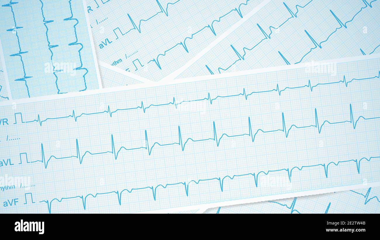 EKG-CTG-Streifen, die als medizinischer Hintergrund, Vektor, über den Tisch verteilt sind. Stock Vektor