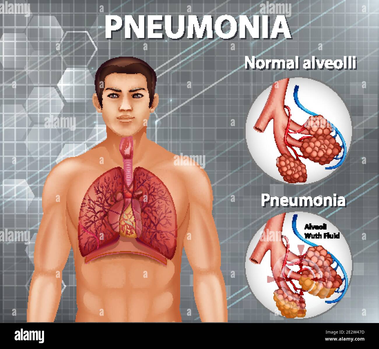 Vergleich von gesunden Alveolen und Lungenentzündung Illustration Stock Vektor