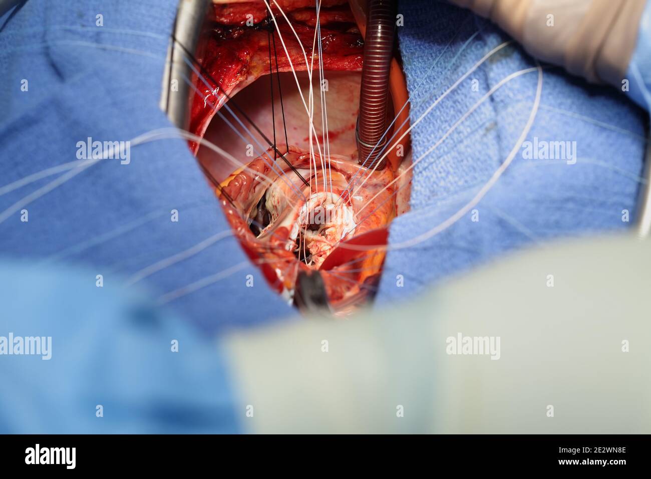 Prozess der Operation am offenen Herzen. Stockfoto