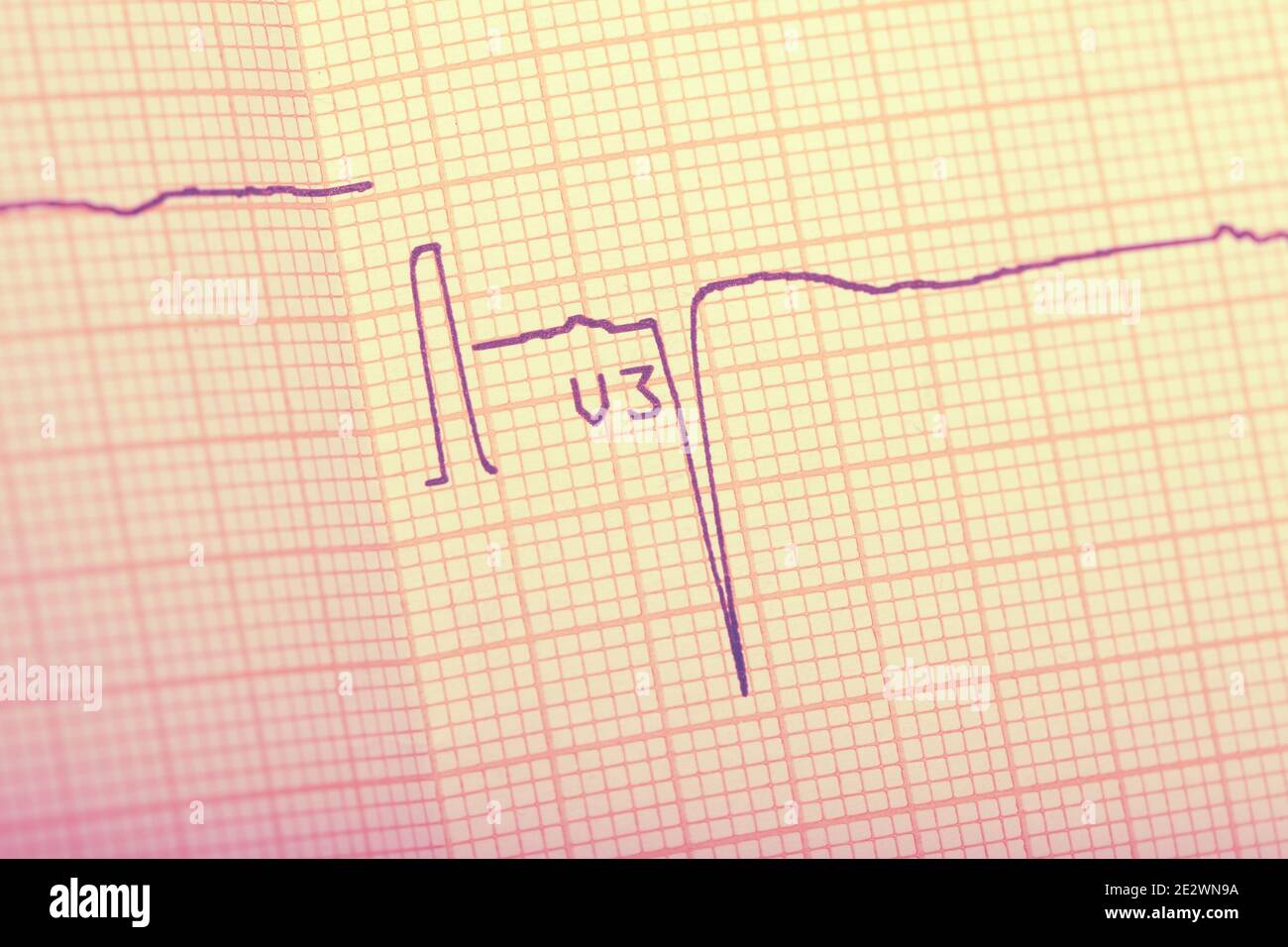 EKG-Ergebnis auf der Nahaufnahme des Papiers. Stockfoto