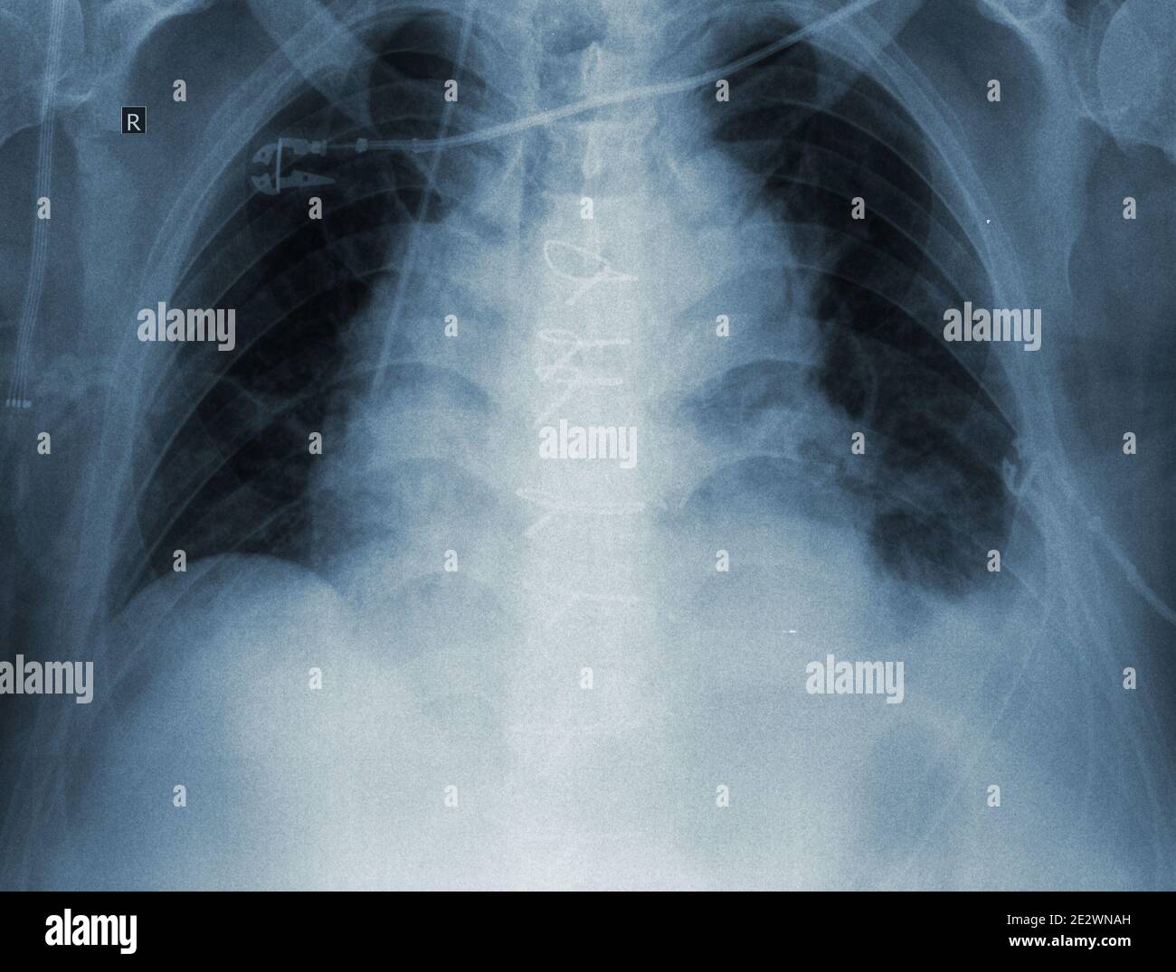 R-Kontrollbild der Lunge des Patienten. Stockfoto