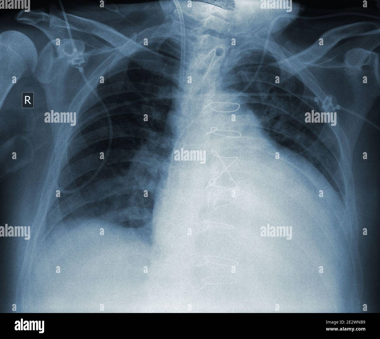 Röntgenaufnahme eines Patienten mit Herzerkrankungen nach der Operation. Stockfoto