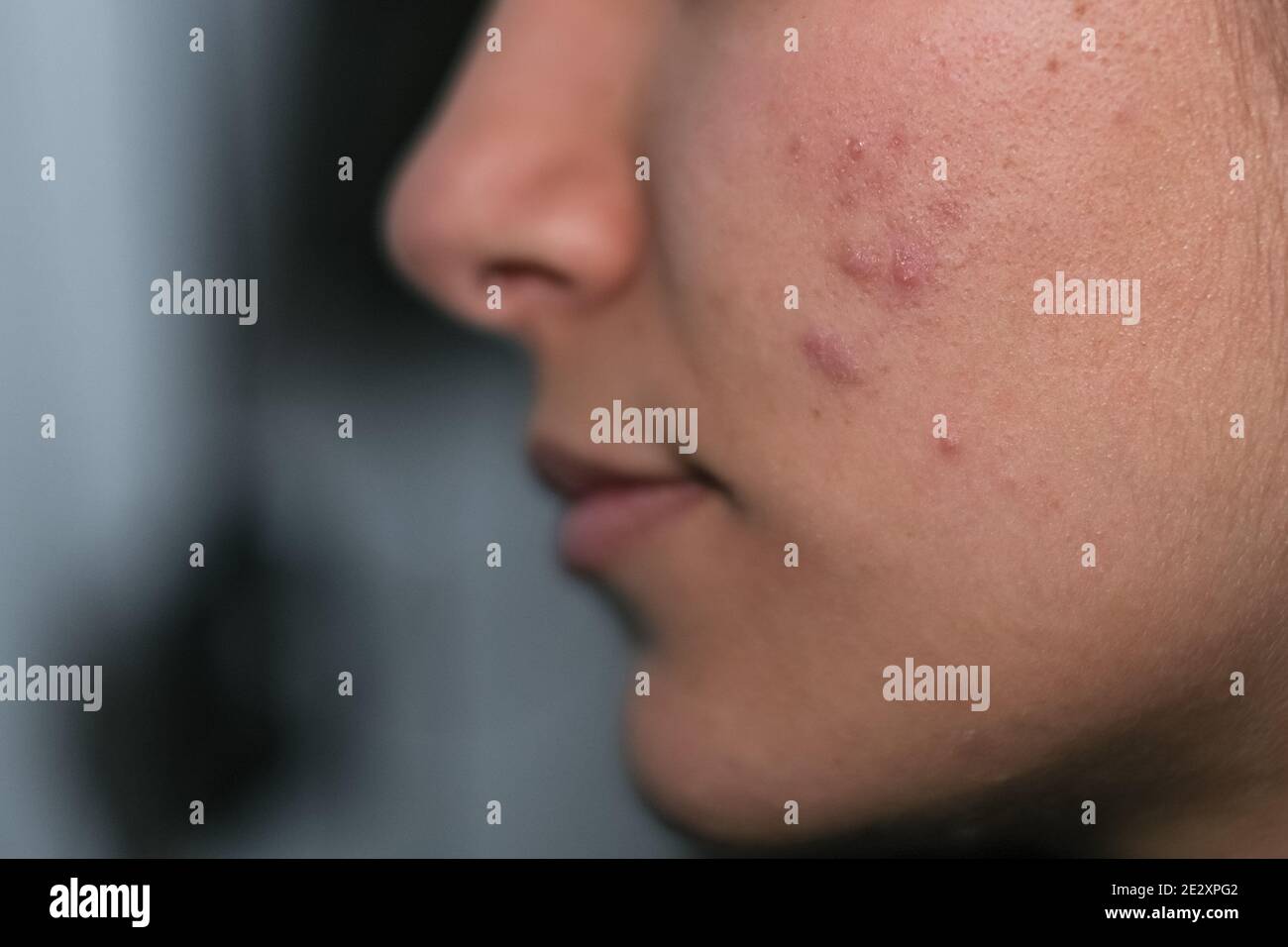 Junge Frau mit Haut Akne Gesicht Nahaufnahme Ansicht, dermatologische Hormone Krankheit Stockfoto
