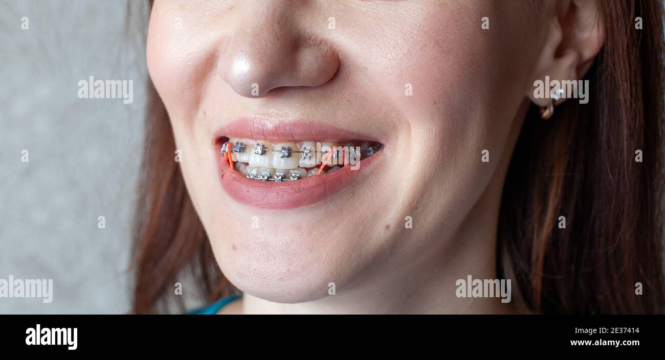 Brasket-System in einem Mädchen lächelnd Mund, Makrofotografie der Zähne. Großes Gesicht und bemalte Lippen. Zahnspange an den Zähnen eines lächelnden Mädchens. Stockfoto
