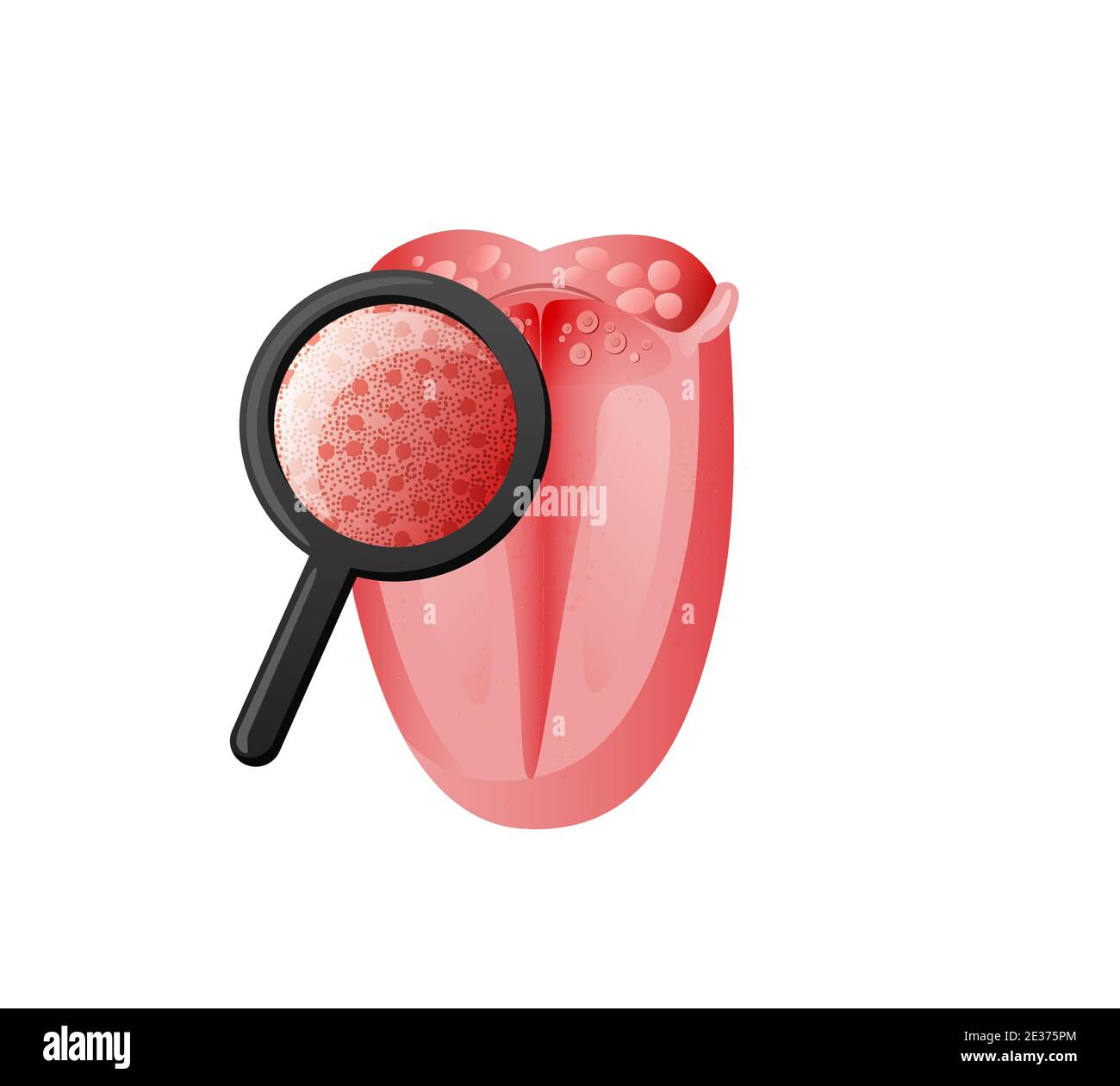 Inspektion Geschmacksrezeptoren auf Zunge Abbildung. Untersuchung von Schleimhäuten unter Lupe auf Anwesenheit Candida. Stock Vektor