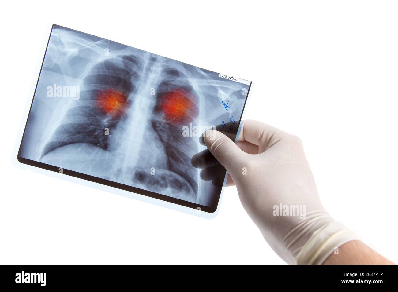 Arzt in medizinischen Handschuh hält Lunge Radiographie mit Anzeichen einer Infektion, isoliert auf weißem Hintergrund Stockfoto