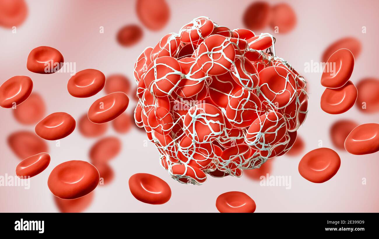 Nahaufnahme eines gerinnten Gerinnsels roter Blutkörperchen, die in Fibrin 3D-Darstellung verwickelt sind. Thrombus, Thrombose, Blutzirkulation, Pathologie, ich Stockfoto